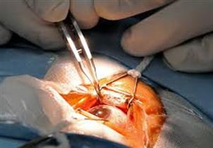 Cataract Surgery